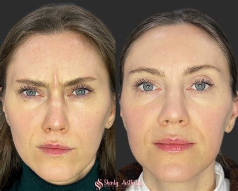 Botox Before and After Results - Everything You Need to See & Know