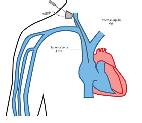 Central Venous Access | Dr Ryan McConell