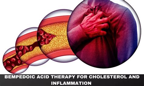 Bempedoic acid reduces cholesterol and inflammation, similar to statin ...