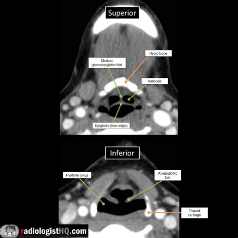 Supraglottic neck anatomy on axial CT : r/Radiology