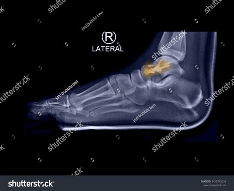 506 Talus Fracture Images, Stock Photos & Vectors | Shutterstock