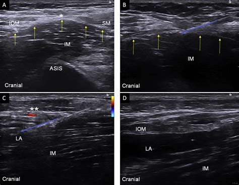 Fascia iliaca compartment block - BJA Education