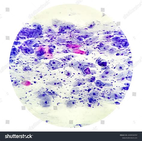 Abnormal Squamous Epithelial Cells View Microscopy Stock Photo ...