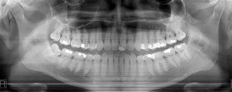 Image result for Tooth Extraction HD Images