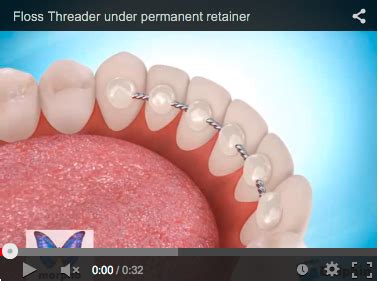 Image result for Floss Threader Fixed Retainer