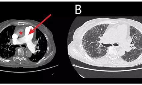 Inhaled treprostinil cuts mortality among patients of pulmonary ...