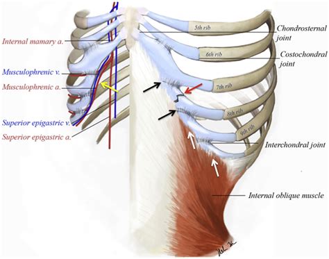 Cough-induced costal cartilage fracture - Clinical Imaging