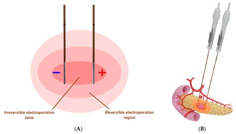 Image-Guided Percutaneous Ablation for Primary and Metastatic Tumors