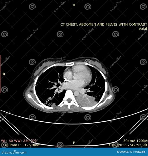 CT Chest Image of Lung Consolidation and Infiltrates Stock Image - Image of imaging ...