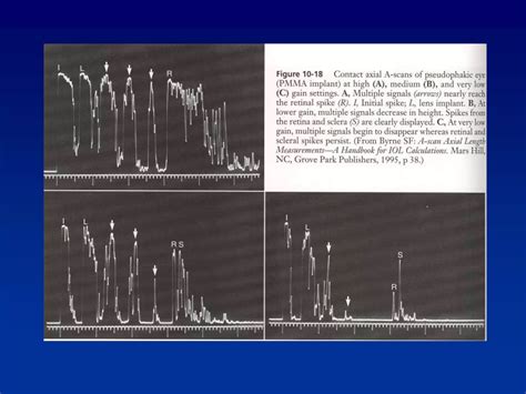 Image result for Biometry Procedure