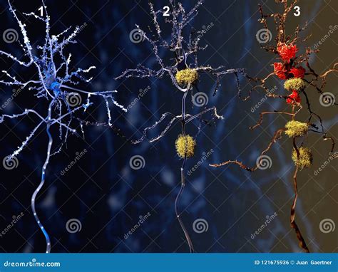 3 Phases of the Alzheimer Disease Stock Illustration - Illustration of alzheimers, cytological ... - phases of alzheimer's disease