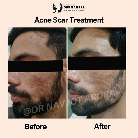 Acne Scar Treatment in Dwarka, Delhi | Dermaheal Skin & Hair Clinic
