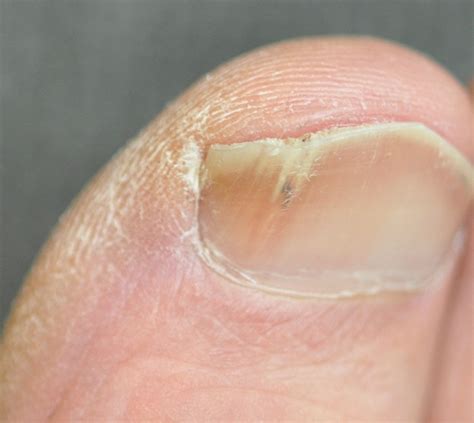 Fungal nail infection: diagnosis and management | The BMJ