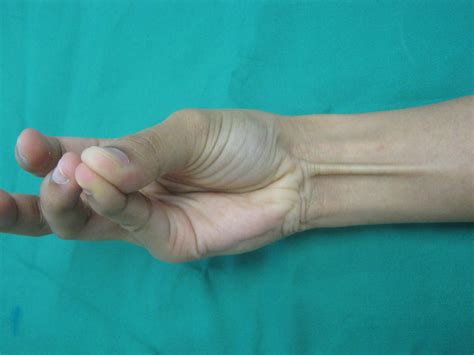 Palmaris Longus Test