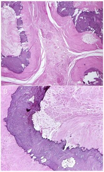 Popcorn Appearance of Severely Calcified Uterine Leiomyoma: Image ...