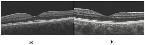 Age-Related Associations of Foveal Structural Parameters in Healthy ...