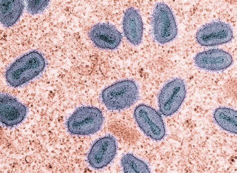 IgA Deficiency Explained: Understanding Your Immune System's Weak Link ...