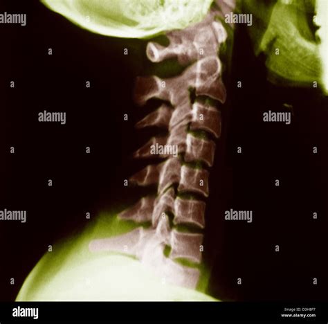 Normal neck x ray hi-res stock photography and images - Alamy