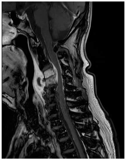 The First Case of Infectious Spondylitis Caused by Gemella bergeri