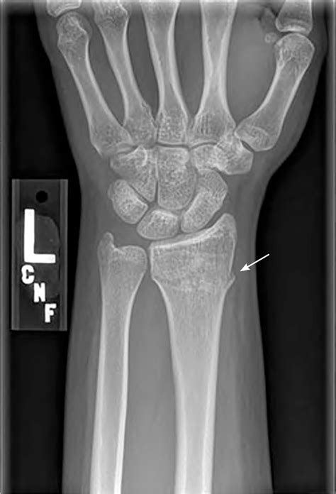 Common Fractures of the Radius and Ulna | AAFP
