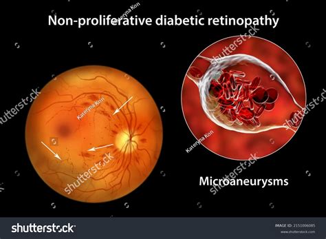 Proliferative Vs Nonproliferative Diabetic Retinopathy