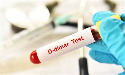 D-dimer testing effective for screening acute aortic syndromes with ...