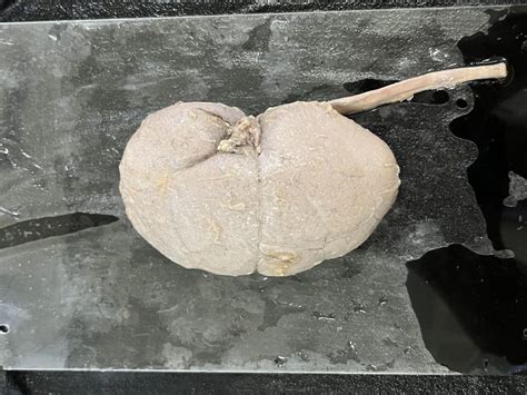 KIDNEY WITH URETER | NAMO Medical Education & Research Institute