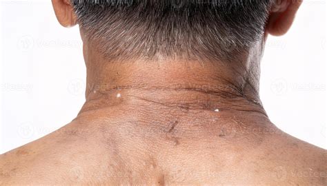 macro image of sagging skin on the back of the neck with deep vertical creases and fine lines in ...