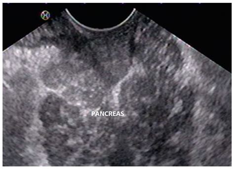 Endoscopic Ultrasound in Pancreatic Duct Anomalies