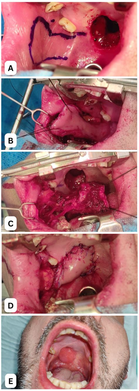 Free Flap Surgery Face