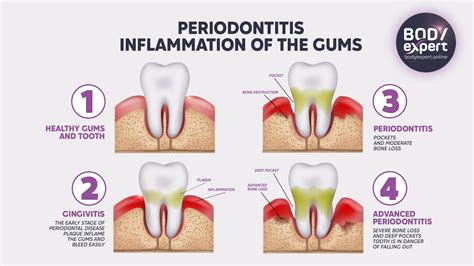 Early Periodontitis Home Treatment Gingivitis And Periodontitis Are