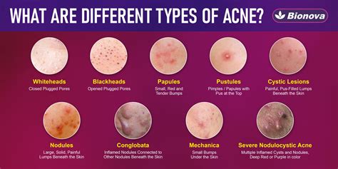 Acne Types: Causes & effective treatment for acne free skin.