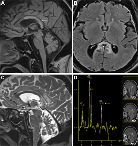 Toxic and Drug-Related White Matter Diseases of the Brain and Spine - Magnetic Resonance Imaging ...