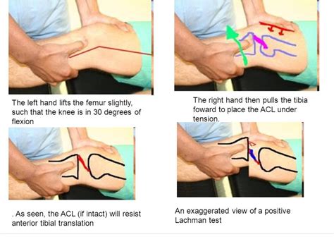 Image result for Lachman Testing