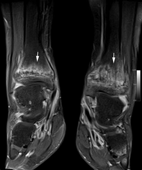 Chronic Recurrent Multifocal Osteomyelitis: Review | AJR