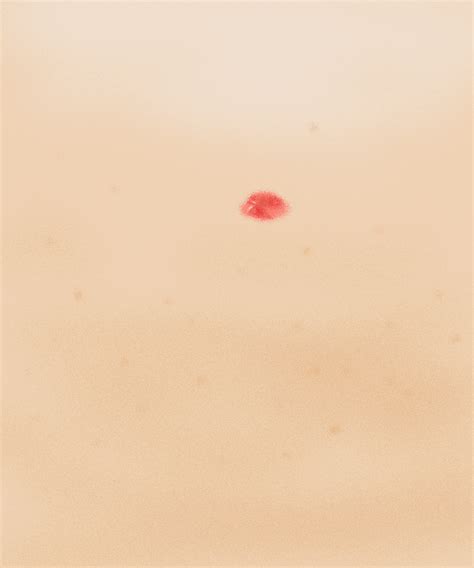 Pinpoint Red Dots On Skin