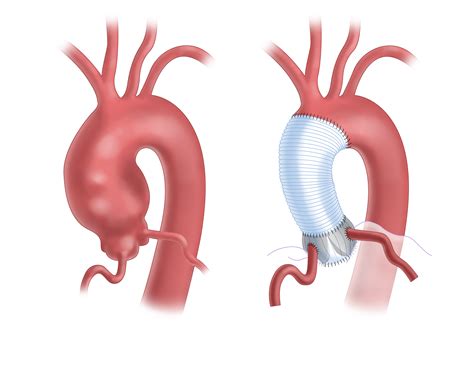 Aortic Root Aneurysm Symptoms and Treatment| UPMC
