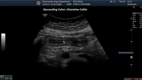 Ulcerative colitis-descending colon [1 image] – EFSUMB