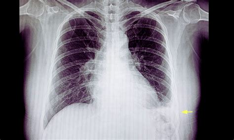 Intrapleural Enzyme Therapy Outperforms Saline Lavage in Pleural ...
