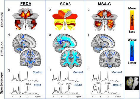 Friedreich Ataxiamarketed And Pipeline Drugs Analysis