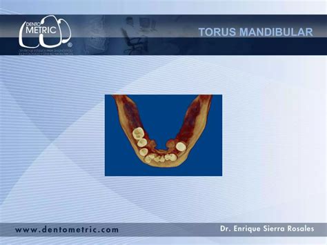Torus mandibular | PPTX