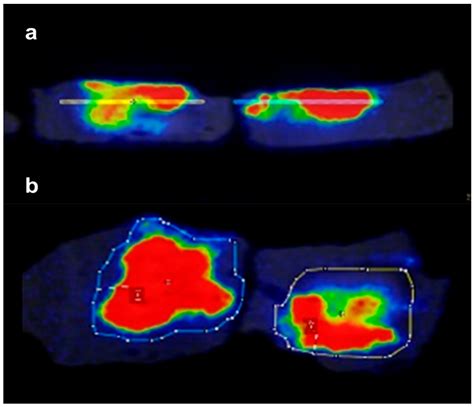 Feasibility of a Drug-Releasing Radiofrequency Ablation System in a ...