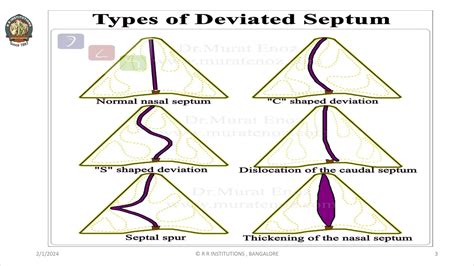 DEVIATED NASAL SEPTUM AND ITS MANAGEMENT.pdf