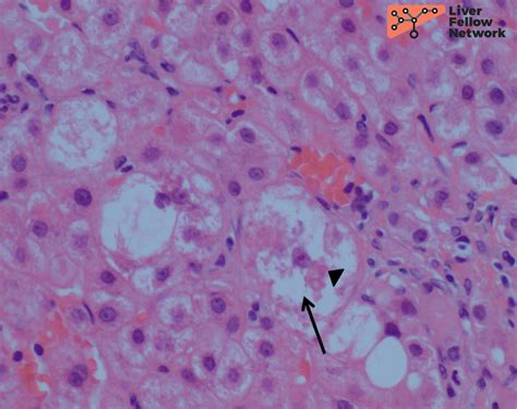 Pathology Pearls: Wilson Disease | AASLD