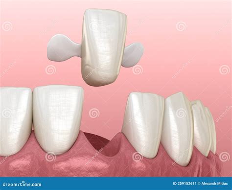 Dental Bridge Front Teeth