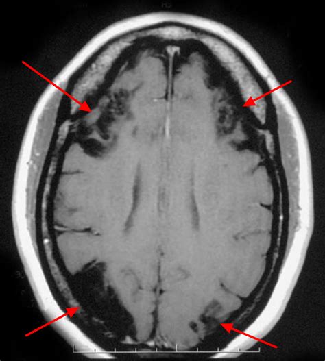 Moyamoya Disease - Causes, Symptoms, Life Expectancy, Treatment