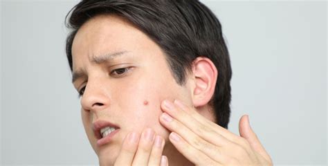 Dr Pimple Popper Guide On How To Squeeze Pimples At Home