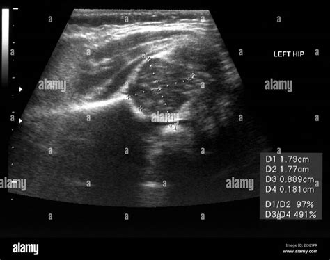 Healthy left hip of a baby, ultrasound scan Stock Photo - Alamy