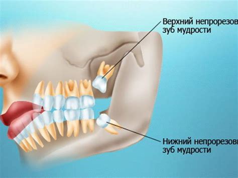 Болит зуб мудрости? Мы поможем!