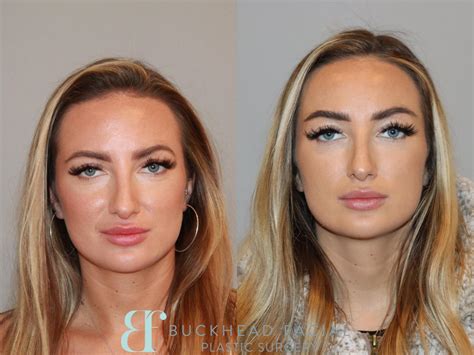 Threading Facelift Before and After 的图像结果